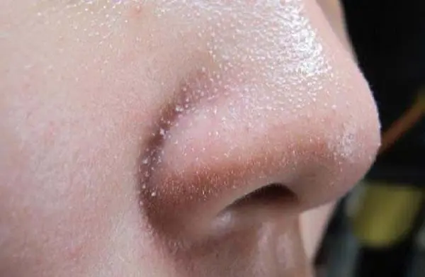 Phân biệt các loại mụn, nguyên nhân hình thành