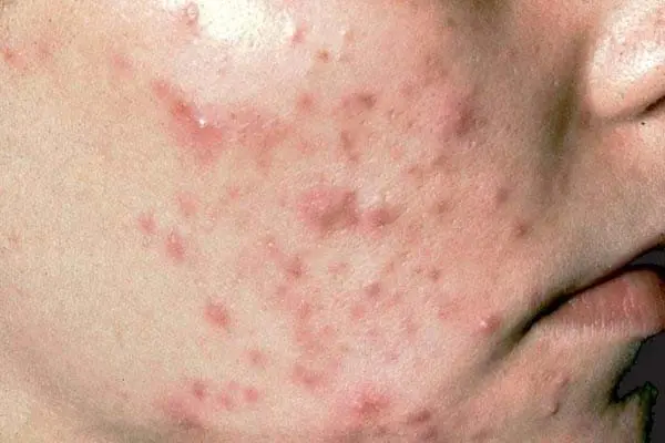 Phân biệt các loại mụn, nguyên nhân hình thành