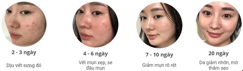 Công dụng của xịt dưỡng Mioskin