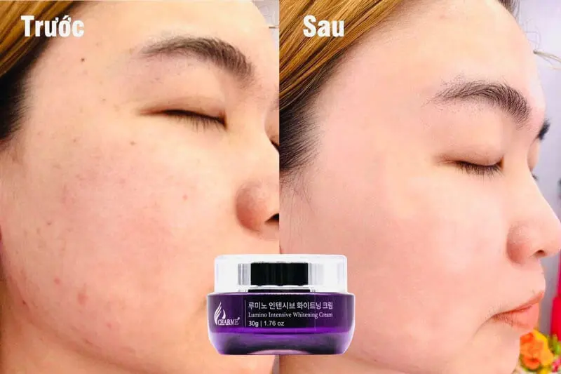 Kem Trị Nám Charme Lumino